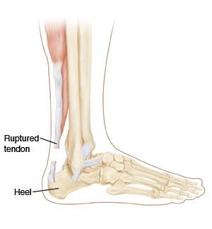 Side view of foot showing bones, ligaments, and ruptured Achilles tendon.