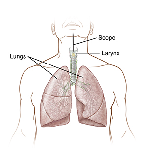 Front view of a male torso showing an endoscope inserted into throat to level of larynx.